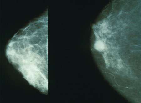 Ann&#160;Oncol：克服乳腺癌耐药将不是梦！研究人员发现导致ER+乳腺癌耐药的基因突变！