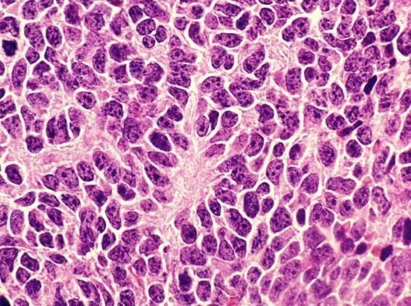 Cancer&nbsp;Cell：重新开启特殊保护性基因的表达有望抵御髓母细胞瘤