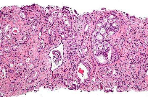 Cell：揭示转移性前列腺癌的基因组特征和结构变异