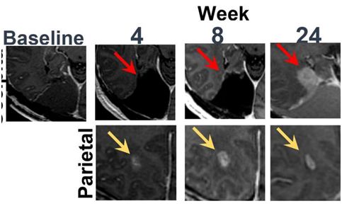 Science子刊：I期临床试验表明药物局部诱导的IL-12基因疗法有望治疗复发性胶质母细胞瘤患者